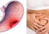 Ce poate determina aparitia cancerului gastric?
