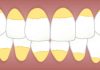 6 trucuri pe care le poti face acasa pentru a indeparta tartrul acumulat pe dinti