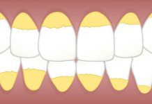 6 trucuri pe care le poti face acasa pentru a indeparta tartrul acumulat pe dinti
