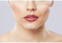 Cum sa eliminati petele de pe piele?