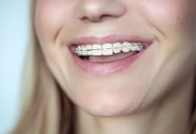 Aparat dentar safir – Combinația ideală între estetică și eficiență