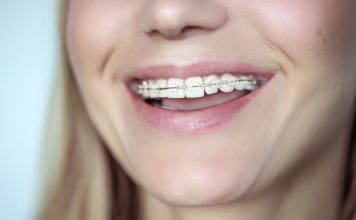 Aparat dentar safir – Combinația ideală între estetică și eficiență